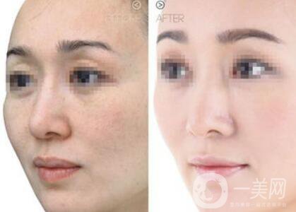 嫩膚多少錢 醫(yī)療美容嫩膚價格詳解