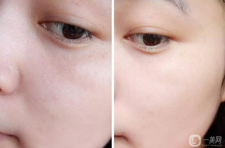 嫩膚多少錢 醫(yī)療美容嫩膚價格詳解