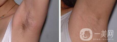 激光脫毛價格在多少 激光脫毛費(fèi)用詳解