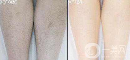 激光脫毛價格在多少 激光脫毛費(fèi)用詳解