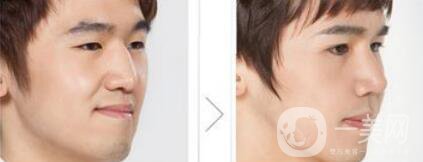 鷹鉤鼻矯正過程 鷹鉤鼻矯正是怎么做的