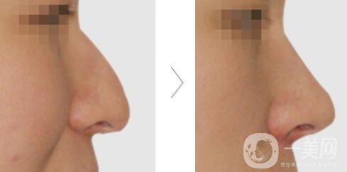 鷹鉤鼻矯正過程 鷹鉤鼻矯正是怎么做的