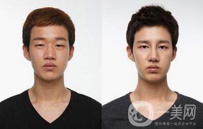 男生割雙眼皮會變帥嗎？