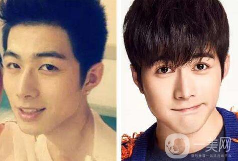 男生割雙眼皮會變帥嗎？