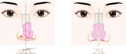 鼻子歪了矯正有危險嗎？