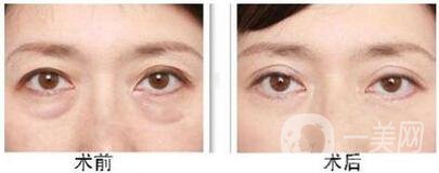 超聲波祛眼袋能保持多久 *果維持幾年