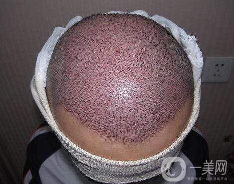 fut植發(fā)技術(shù)怎么樣 fut植發(fā)技術(shù)好不好