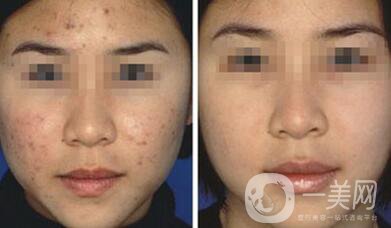 果酸換膚*果怎么樣 果酸換膚*嗎