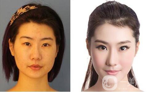 下頜角截骨手術(shù)會(huì)復(fù)發(fā)嗎？