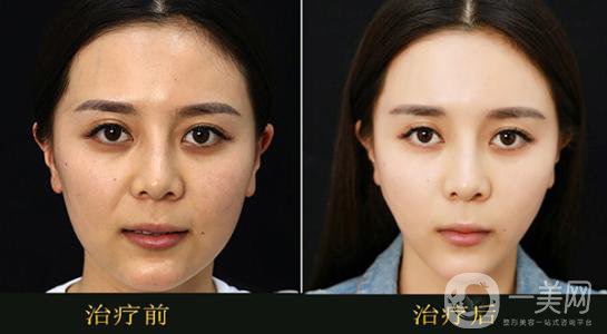 醫(yī)院果酸換膚多少錢(qián) 價(jià)格詳情