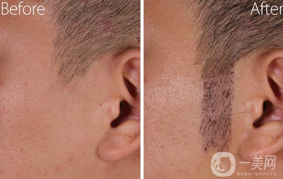 植鬢角大概多少錢 鬢角種植價格詳解