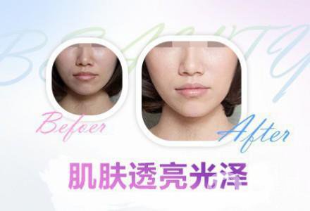 果酸換膚的功* 有哪些好處？