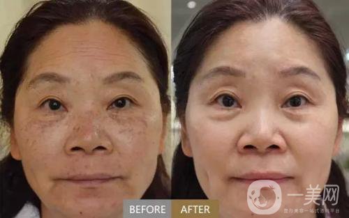 老年斑如何去除 方法介紹一覽