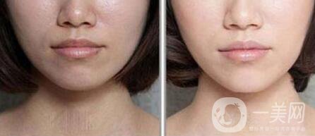 光子嫩膚管用嗎 光子嫩膚有什么*果