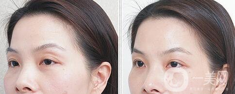 自體脂肪豐眼窩缺點 自體脂肪豐眼窩為什么不好
