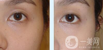 自體脂肪豐眼窩缺點 自體脂肪豐眼窩為什么不好