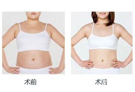 360度環(huán)形吸脂有哪些術(shù)后注意事項(xiàng)？