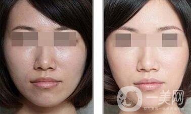 做果酸換膚多少錢一次 果酸換膚具體價格