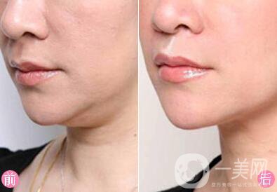 如何去雙下巴 去除雙下巴的方法有哪些