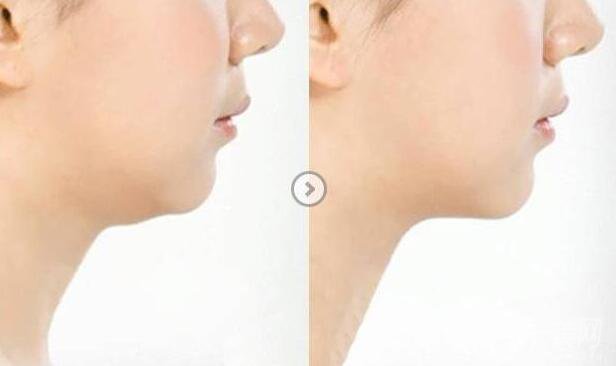 如何去雙下巴 去除雙下巴的方法有哪些