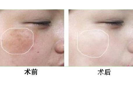 *風(fēng)范祛斑多少錢一次 與哪些因素有關(guān)？