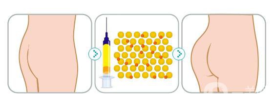 做自體脂肪豐臀手術(shù)的危害有哪些？