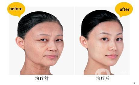 *生物除皺*果怎么樣？能持續(xù)多久？