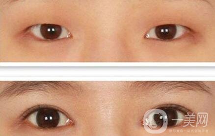 哪里割雙眼皮好 割雙眼皮醫(yī)院介紹