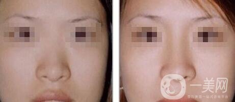 隆鼻后消腫的方法 隆鼻后怎么護理恢復快