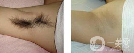 激光脫毛信息介紹 哪個(gè)醫(yī)院做激光脫毛好