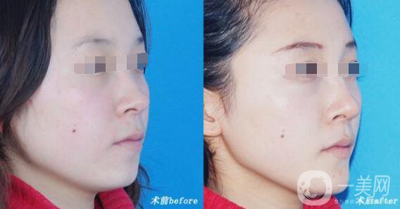 *恢復(fù)期注意事項 *術(shù)后護理