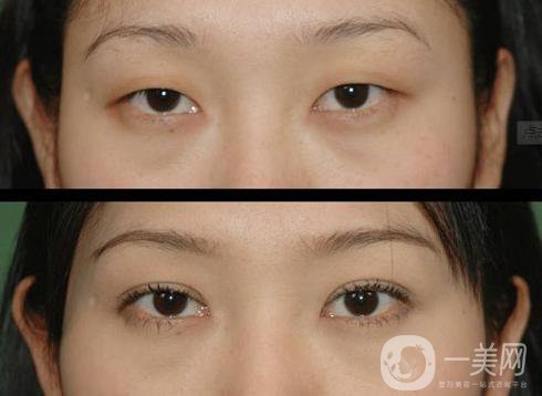 北京哪家醫(yī)院割雙眼皮*果好？