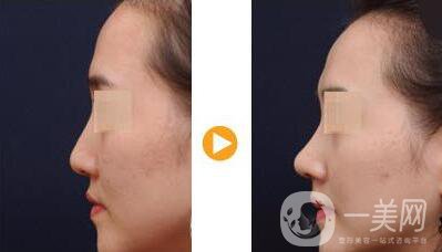 隆鼻山根多久消腫定型 隆鼻后多久完全恢復(fù)