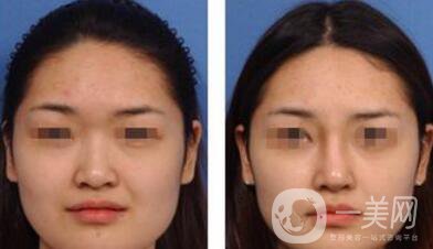 硅膠墊鼻梁能保持多久 硅膠隆鼻保持幾年