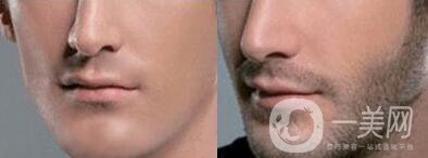 植胡須費用  胡須種植手術(shù)要多少錢