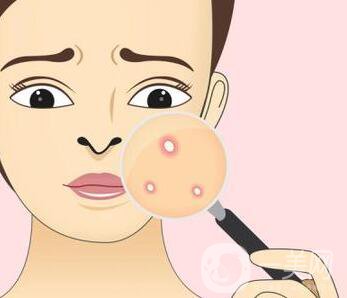 快速*去痘印的方法有哪些？