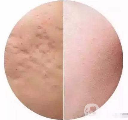 快速*去痘印的方法有哪些？