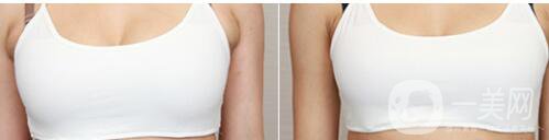 副乳吸脂,風(fēng)險