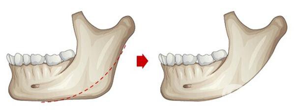 磨骨手術(shù)做完有些什么后遺癥？