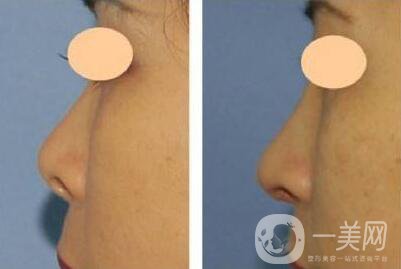 朝天鼻修復(fù)