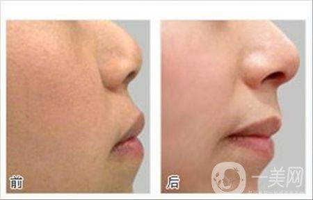 光子嫩膚前后*果嗎 *果怎么樣？