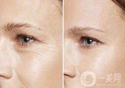 *去魚(yú)尾紋多少錢(qián) 價(jià)格是多少