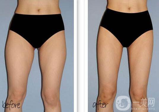 超聲波抽脂缺點 超聲波抽脂的缺點有哪些