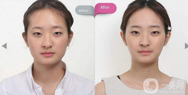 面部磨骨手術(shù)價格 面部磨骨手術(shù)多少錢