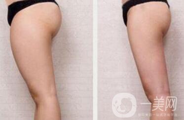 360度環(huán)形抽脂價格 吸脂減肥*果圖