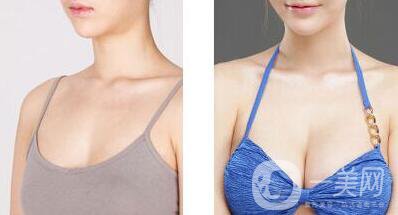 妙桃豐胸一次多少錢 妙桃假體隆胸具體價(jià)格