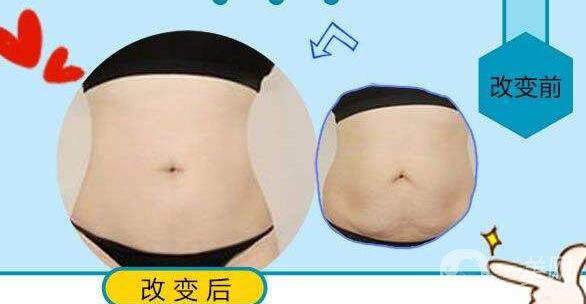 吸脂,多少錢(qián)