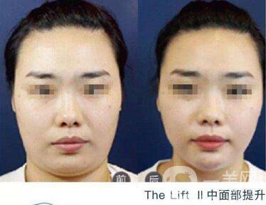塑美極面部提升價(jià)格 塑美極面部提升要多少錢
