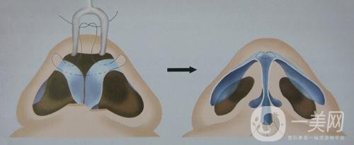 耳軟骨墊鼻梁大概需要多少錢呢？
