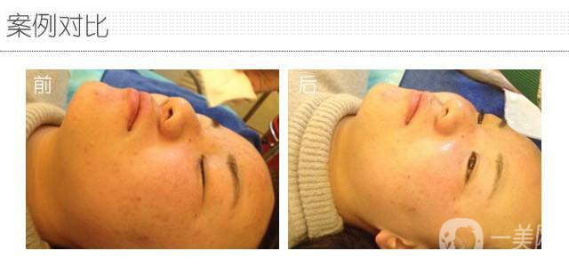 果酸換膚術(shù)做一次多少錢？